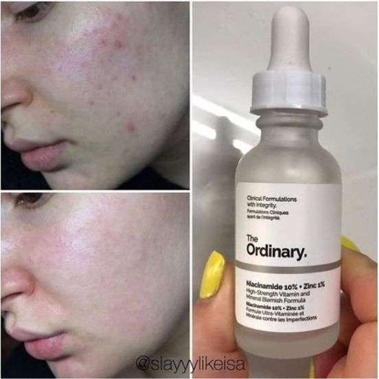 The Ordinary's Niacinamide 10% + Zinc 1% Serum